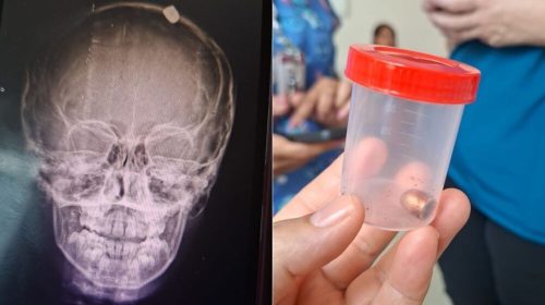 Raio-x-revela-bala-alojada-no-crânio-de-menino-atingido-durante-virada-do-ano-em-Contagem